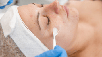 What are chemical peels?